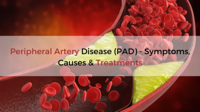 signs of peripheral artery disease in early stages